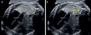 Medición del pulmón para el cálculo del LHR. a) usando trazado del contorno pulmonar. b) usando medida de diámetros máximos.