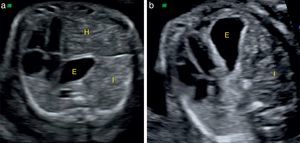 Valoración de la presencia de herniación hepática. a) HDC izquierda con herniación hepática. b) HDC izquierda sin herniación hepática. E: estómago; H: hígado; I: asas intestinales.