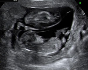 Imagen ecográfica de una gestación monocorial de 13 semanas con secuencia de perfusión arterial reversa,. El feto de la parte superior es claramente acardio y acéfalo.