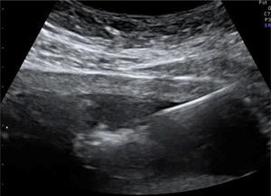 Imagen ecográfica del momento de ablación vascular percutánea ecoguiada con láser diodo del feto acardio.