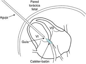 Esquema de la técnica de la valvuloplastia aórtica fetal. VD: ventrículo derecho; VI: ventrículo izquierdo.