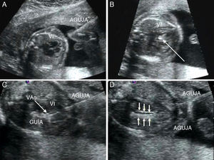 Valvuloplastia aórtica fetal. A) La aguja se orienta hacia el ápex cardiaco tras haber atravesado la pared abdominal materna, el miometrio y la cavidad amniótica. B) Tras atravesar la pared torácica fetal y el miocardio, la punta de la aguja (flecha), se sitúa inmediatamente debajo de la válvula aórtica. C) La guía se hace avanzar a través de la válvula aórtica (VAo) estenosada hacia la aorta ascendente. D) El catéter-balón (flechas) es inflado, consiguiendo la dilatación de la válvula aórtica. VI: ventrículo izquierdo.