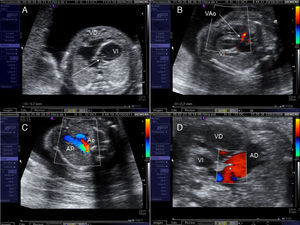 Criterios de selección para intervencionismo cardiaco fetal en la estenosis aórtica crítica. A) Z-score del anillo mitral≥-3. B) Flujo anterógrado a través de la válvula aórtica (VAo). C) Relleno retrógrado del arco transverso desde el ductus arerioso. D) Flujo invertido a través del foramen oval de la aurícula izquierda (AI) a la aurícula derecha (AD). Ao: arco aórtico; AP: arteria pulmonar; VI: ventrículo izquierdo.
