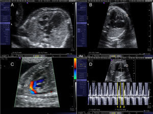 Criterios de selección para intervencionismo cardiaco fetal en la estenosis pulmonar crítica/atresia pulmonar con septo íntegro. A) Cociente entre los anillos tricúspide y mitral≤0,75. B) Cociente entre las longitudes del ventrículo derecho (VD) e izquierdo (VI)≤0,64. C) Relleno retrógrado ductus-dependiente del tronco pulmonar en feto con atresia membranosa de la válvula pulmonar y septo íntegro. D) Cálculo del cociente tiempo de llenado del ventrículo derecho (1-2)/tiempo del ciclo cardiaco (1-3) mediante Doppler pulsado.