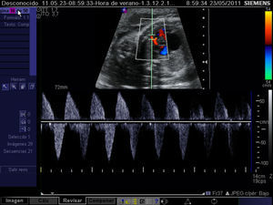 Registro mediante Doppler pulsado del flujo bidireccional de una fístula ventrículo-coronaria en feto diagnosticado de atresia pulmonar con septo íntegro.