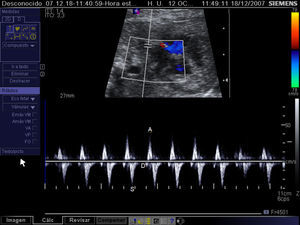 Registro mediante Doppler pulsado del flujo en una vena pulmonar en un feto con ventrículo izquierdo hipoplásico y foramen oval sellado. Obsérvese la ausencia de flujo durante la primera fase de la diástole (onda D) y el pico revertido coincidiendo con la contracción atrial (onda A). Onda S: flujo durante la sístole.