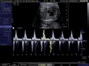 Análisis de la onda de Doppler pulsado del flujo en una vena pulmonar en un feto con ventrículo izquierdo hipoplásico y foramen oval restrictivo, no sellado. Cálculo de la integral de velocidad tiempo de las ondas de flujo anterógrado (componentes S y D) y reverso (onda A).