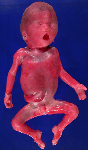 Imagen macroscópica del feto, se observa la proptosis y el hipertelorismo.