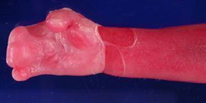 Imagen macroscópica del feto, detalle de la sindactilia en la mano.