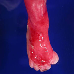 Imagen macroscópica del feto, detalle de la sindactilia.