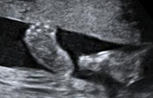 Imagen en 2D muestra anomalía posicional de los pies (cavos).
