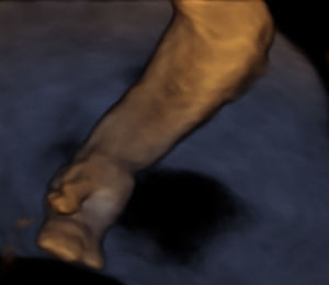 Reconstrucción 3D, se observa sindactilia de la mano.