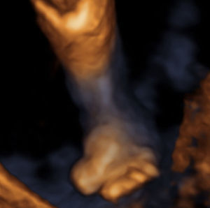 Reconstrucción 3D del pie con sindactilia.