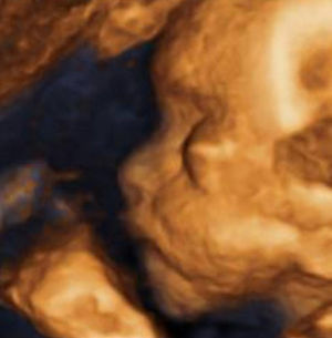 Reconstrucción 3D de la cara de perfil, se evidencia la proptosis.