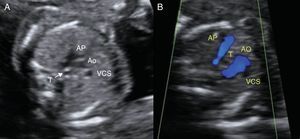 Imagen ecográfica del arco aórtico en el corte axial tres-vasos-tráquea. A) Arco aórtico izquierdo normal (20 semanas de gestación). B) Arco aórtico derecho con Doppler color (arco aórtico derecho); se visualiza el trayecto anómalo del arco aórtico a la derecha de la tráquea (20 semanas de gestación). Ao: aorta; AP: arteria pulmonar; T: tráquea; VCS: vena cava superior.