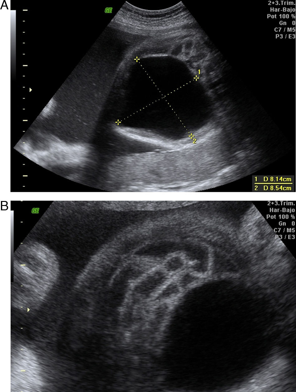 Síndrome de Berdon: diagnóstico intrauterino y evolución posnatal ...