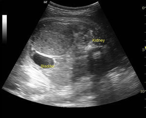Intraabdominal diffuse hypoechoic solid appearing mass with posterior acoustic enhancement. Foetal kidney and bladder seen separate from the mass.