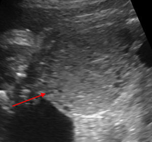 Daughter cysts seen at periphery of the ovarian cyst.