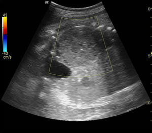 Colour Doppler showing no flow in the cyst antenatally.