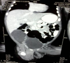 CT abdomen of the newborn with a mass above the bladder.