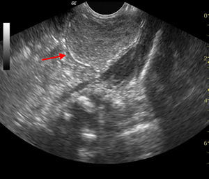Neonatal ultrasound showing cyst in the ovarian fossa with dystrophic calcification.