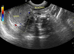 Neonatal Doppler USG of the ovarian cyst suggesting torsion.