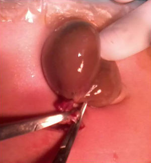 Intraoperative torsion ovarian cyst.