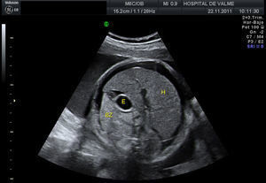 Se visualiza hepatomegalia (H), estómago (E), bazo (BZ) y ascitis fetal.