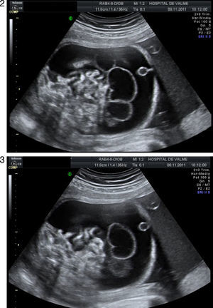 Se determinan diferentes cortes abdominales donde se observa la ascitis fetal en relación con las asas abdominales.