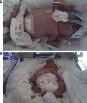 Imágenes del neonato con aumento del perímetro abdominal debido a la ascitis y la hepatomegalia.