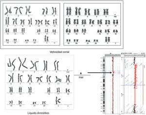 Caracterización de un cromosoma marcador no bisatelitado mediante técnicas de array CGH (caso 25).
