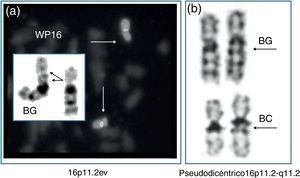 Variantes eucromáticas detectadas posnatalmente. a) Bandas G (BG) y pintado cromosómico (WP16) de un 16p11.2ev. b) Bandas G (BG) y C (BC) de un pseudodicéntrico 16p11.2-q11.2.