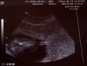 Ecografía vaginal, caso 2. La pantorrilla fetal aparece acortada con un pequeño muñón distal que remeda un pie.