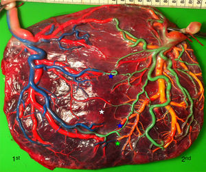 Normal MC placenta (gestational age at delivery: 28 weeks) showing several AV and VA anastomoses (green and white stars, respectively) and 2 AA anastomoses (blue stars).