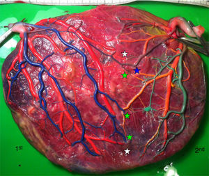 TTTS placenta treated with amnioreduction (gestational age at delivery: 33 weeks) showing several AV anastomoses (green stars) and VA anastomoses (white stars) and 1 AA anastomosis (blue star).