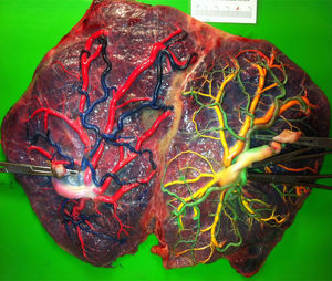 TTTS placenta treated with laser using the Solomon technique (gestational age at delivery: 37weeks). No residual anastomoses were found. Note the laser line dividing completely the vascular equator.