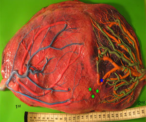 Spontaneous TAPS placenta (gestational age at delivery: 33 weeks) showing 3 small AV anastomoses (green stars) and 1 small AA anastomosis (blue star). Note the difference in color between the plethoric placental share of the recipient and the pale placental share of the donor.