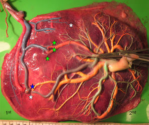 sIUGR placenta (gestational age at delivery: 29 weeks) showing 3 AV anastomoses (green stars), 2 VA anastomoses (white stars) and 1 large AA anastomosis (blue star). The growth restricted fetus (1st fetus) has a velamentous cord insertion and a small placental share (left side of the picture).