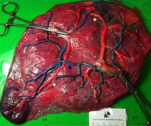 MA placenta with paracentral cord insertions (gestational age at delivery: 31 weeks) showing 1 AA anastomosis (blue star), 1 VV anastomosis (yellow star) and 1 VA anastomosis (white star).