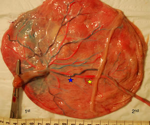 TRAP placenta (gestational age at delivery: 23 weeks) showing a large AA (blue star) and VV anastomosis (yellow star). Placental share on the left-side of the picture belongs to the pump twin and on the right-side to the acardiac twin.