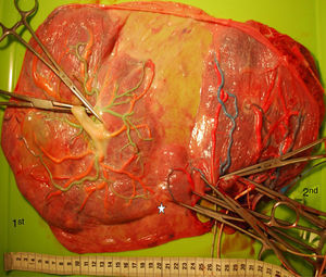 Bipartite placenta (gestational age at delivery: 36 weeks) showing two separate placental masses connected with each other through the amniotic membranes. The white star indicates a VA anastomosis near the placental margin.