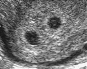 Dichorionic twin pregnancy at 5 weeks 3 days. Two round sonolucent sacs with a brightly echogenic rim are clearly visible in the thick decidua.