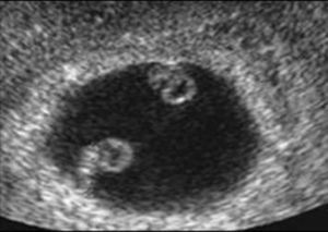 At 6 postmenstrual weeks a single chorionic sac is seen containing two yolk sacs: the diagnosis of monochorionic twin pregnancy can be done; it is not possible yet to diagnose amnioticity.
