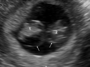 Monochorionic diamniotic twin pregnancy at 8 postmenstrual weeks. The two amnions appear as thin echogenic membranes (arrows) close to the two embryos, inside the celomatic cavity.