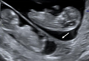 Twin peak sign (arrow) in a dichorionic twin pregnancy in the first trimester.