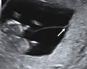 T-sign (arrow) in a monochorionic twin pregnancy in the first trimester.