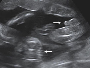 Dichorionic twin pregnancy in the second trimester. Arrows point to the fetal genitalia (female on the left and male on the right).
