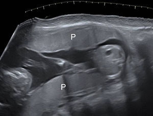Dichorionic twin pregnancy in the second trimester: two widely separated placental masses (P) can be seen, one on the anterior and one on the posterior wall of the uterus.
