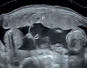 Twin pregnancy in the second trimester: a single placental mass (A) is seen on the anterior wall of the uterus. The chorionicity cannot be determined on the only base of the placental masses.