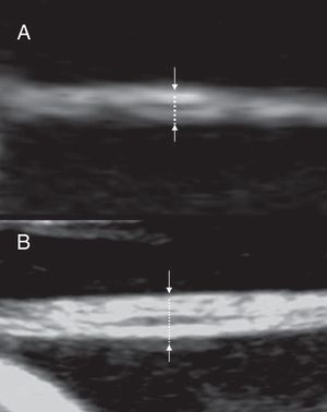 Evaluation of the inter-twin membrane in the second trimester. The membrane is imaged perpendicularly to the ultrasonic beam and magnified. (A) monochorionic twins: two layers may be seen and the thickness is below 2mm (B) dichorionic twins: more than two layers may be seen and the thickness is above 2mm.